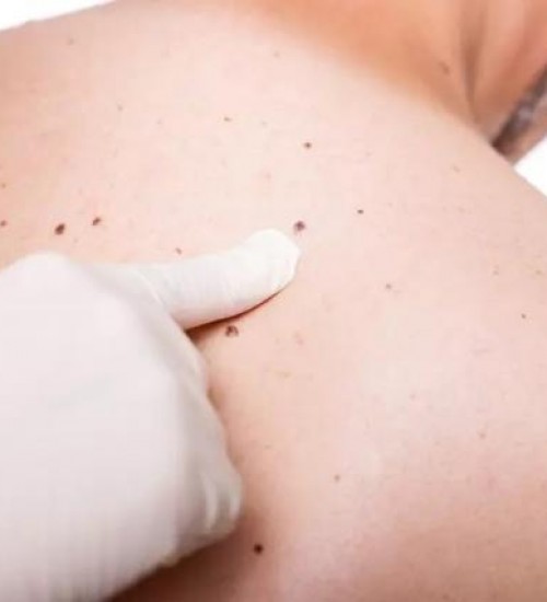 Ministério da Saúde abre consulta pública para diagnosticar câncer de pele.