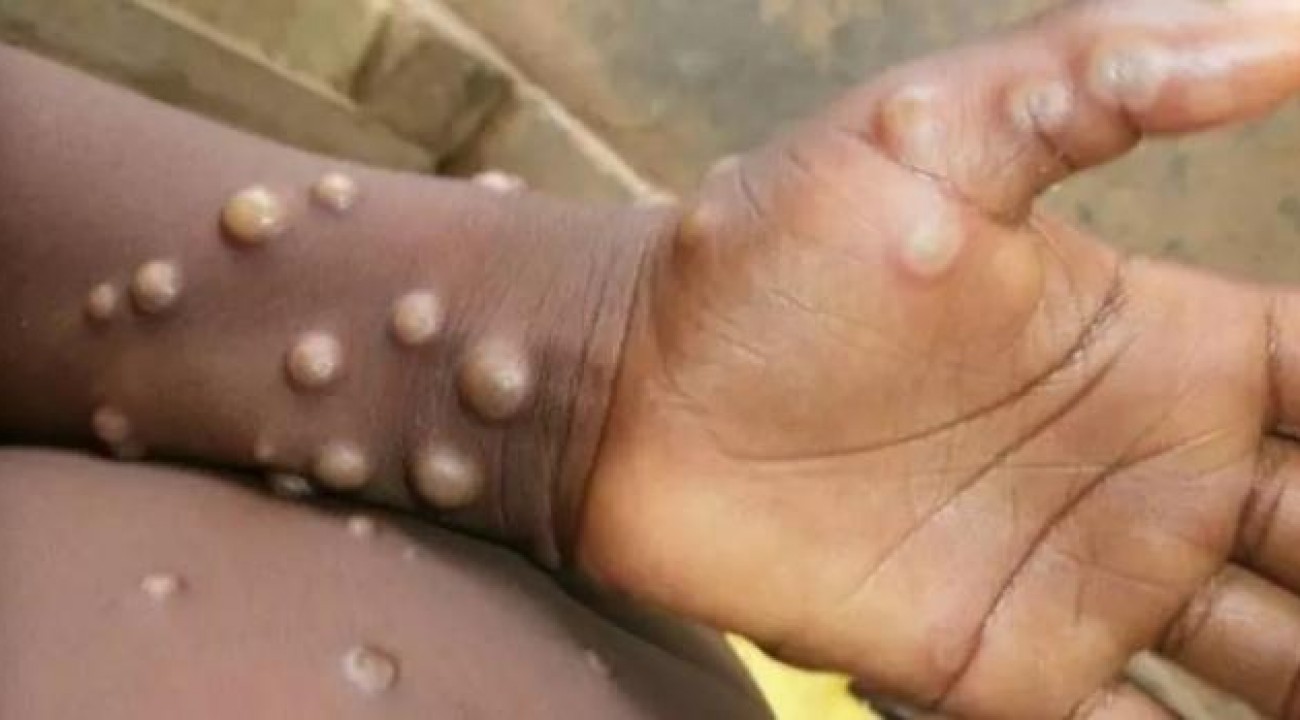 SC monitora varíola do macaco após 90 casos confirmados em ao menos 12 países.