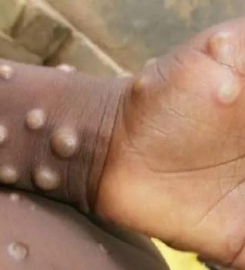 SC monitora varíola do macaco após 90 casos confirmados em ao menos 12 países.